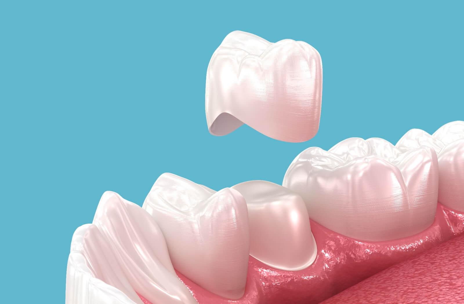 A diagram showing a crown going over a tooth